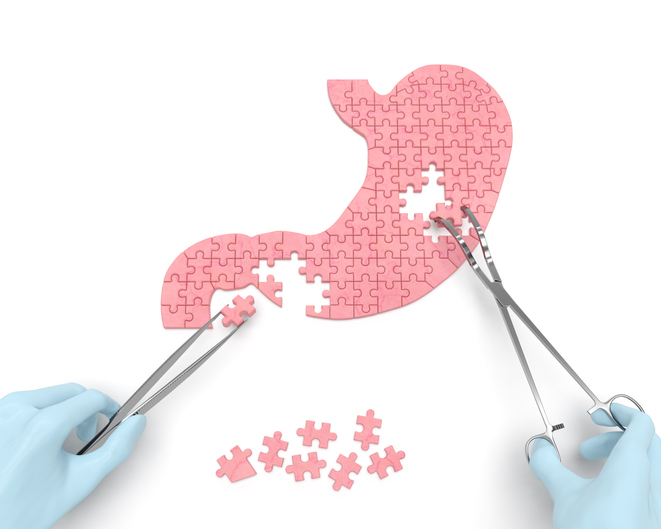 Weight loss surgery operation shown as a puzzle concept with hands of surgeon