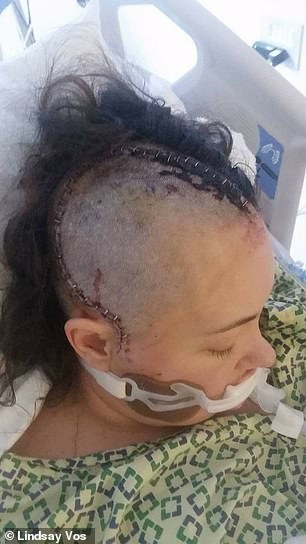 In 2017, Lindsay Vos underwent a dangerous brain surgery to remove a tangle of blood vessels that could have burst at any moment and killed her