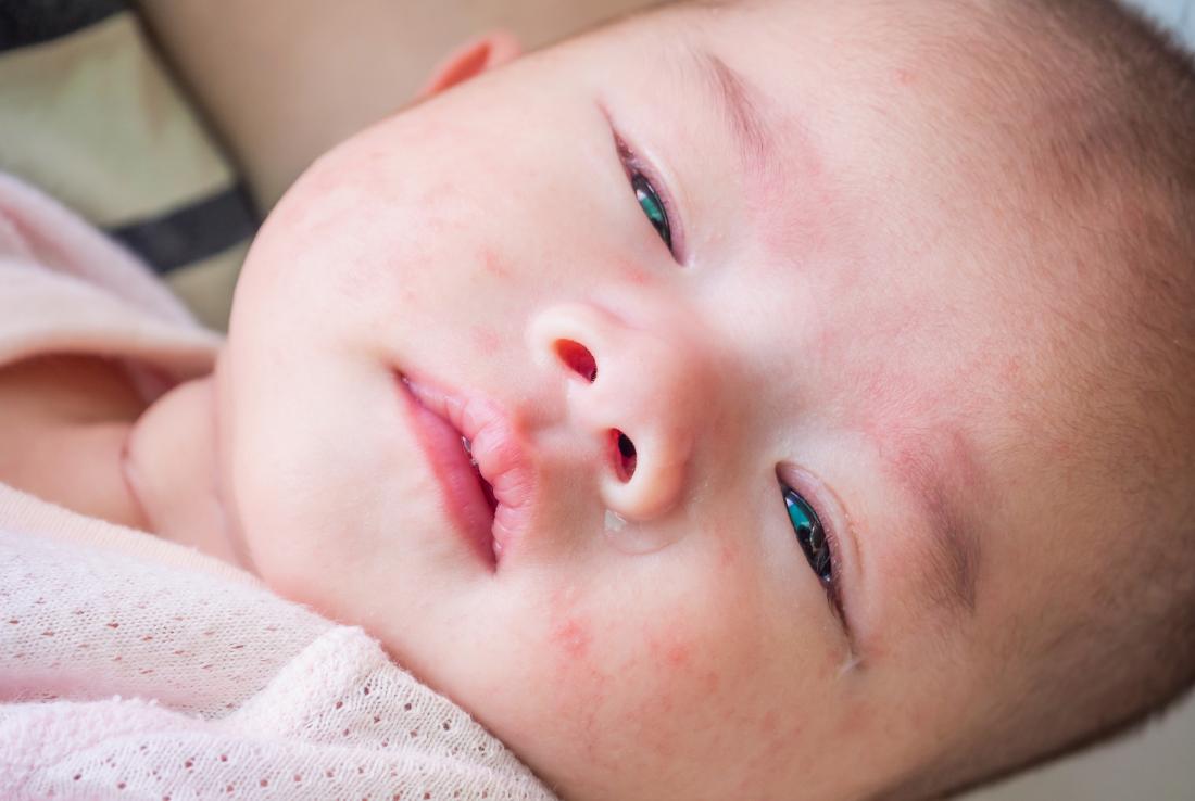 Baby with allergic rash and eczema on face.