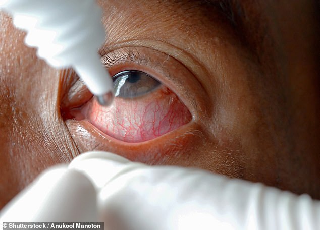 A woman, whose name and age are unknown, was left with a red, swollen and infected eye after she ended up rubbing erectile dysfunction cream into it (stock image)