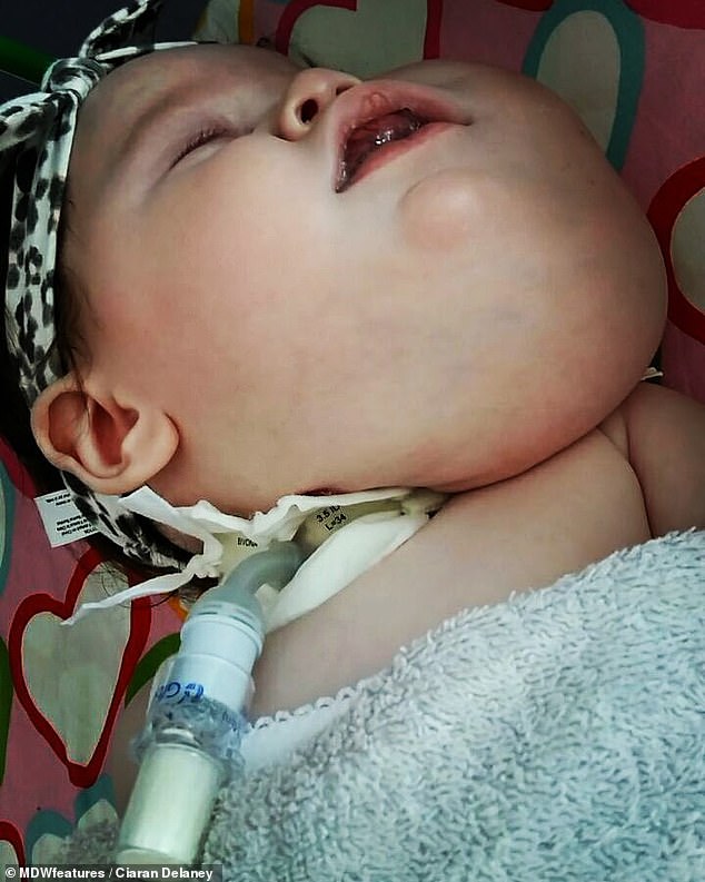 Evie wasn't able to breathe if the cord was cut so she had to have a tracheostomy which is an artificial opening of the airways