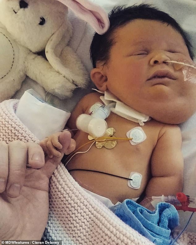 Evie was delivered through an EXIT procedure, which reportedly needed 37 medical staff drafted in from three hospitals. The procedure is used to deliver babies who have breathing difficulties. Babies do not breathe in the womb. Evie is pictured in hospital