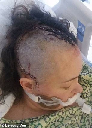 Half of her hair had to be shaved so Dr Bain's team could male a long incision to access her skull and the area of Lindsay's brain where the AVM was