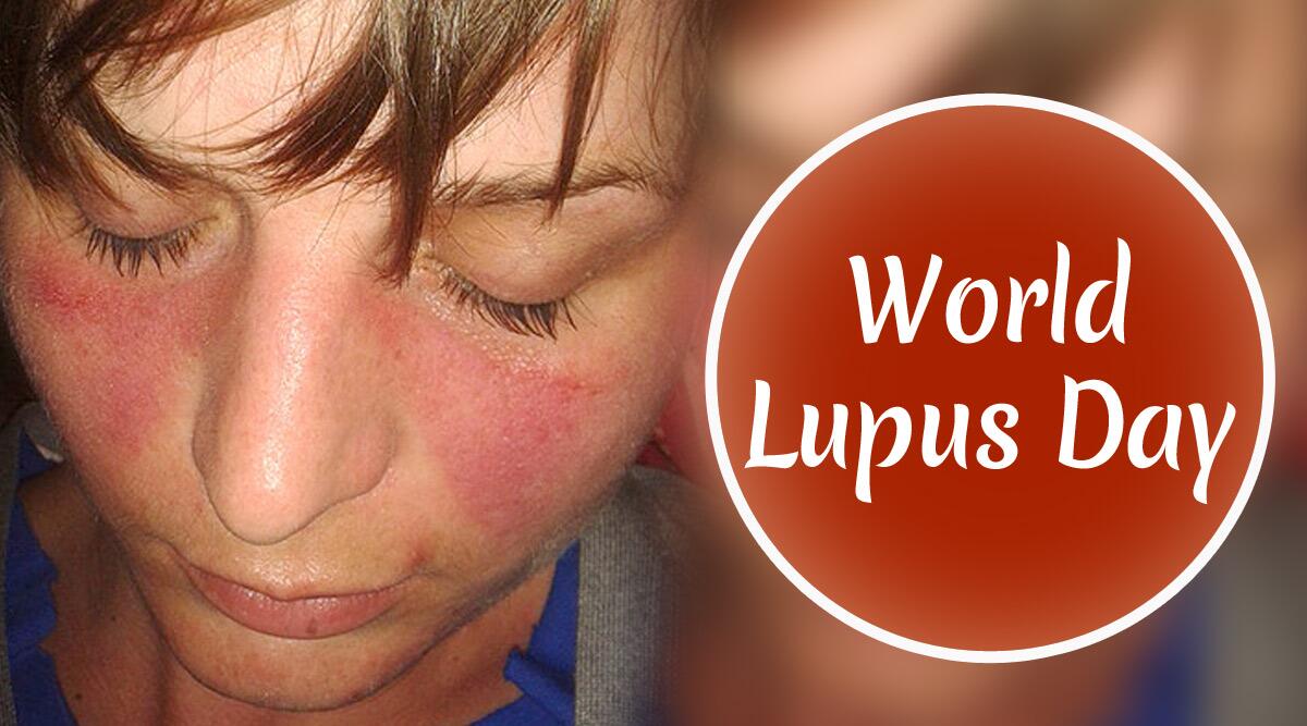 World Lupus Day 2020: What Is Lupus? Know More About the Causes and Symptoms of the Autoimmune Disease