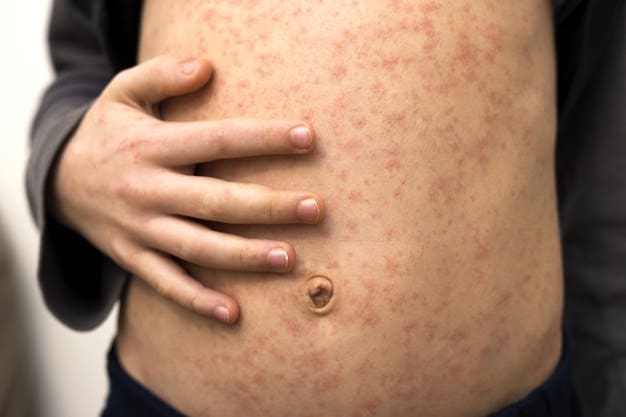 Measles Outbreak Europe